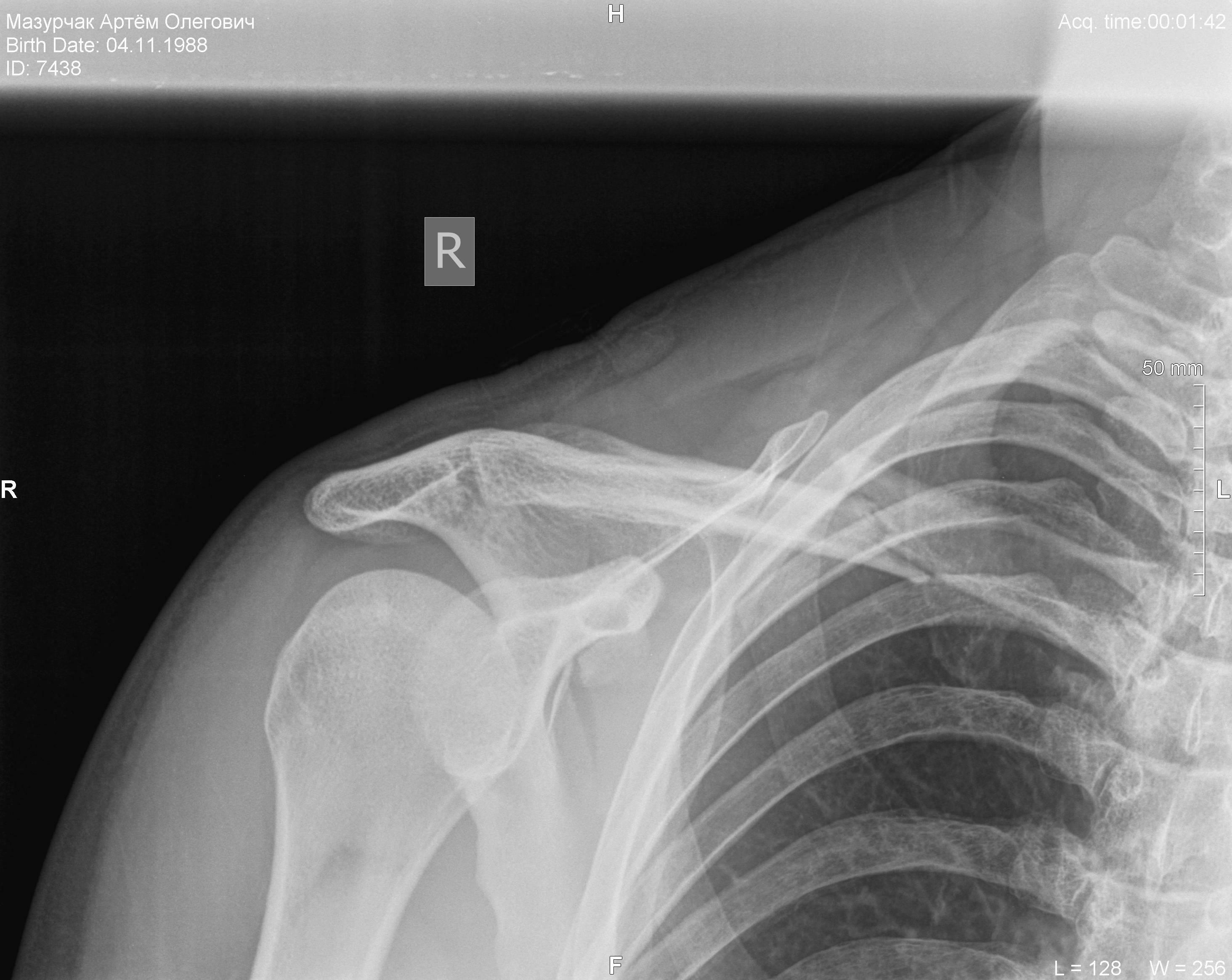 X-ray of a right shoulder and collarbone region, labeled with patient name and 50 mm scale.